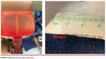Figure showing aspirated material; a gross specimen.