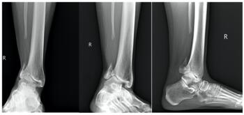 These images show the bone defect in question as an adult.
