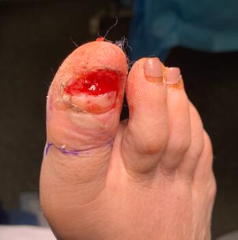 Here one can see removal of biologic graft. Surgeons planned for partial hallux amputation.