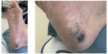 An 86-year-old male with a past medical history of hypertension and colon cancer presented to the office with a dark pigmented spot of skin to the posterior medial heel.