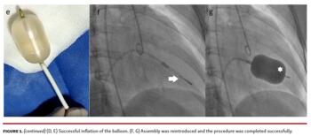 Successful inflation of the balloon. Assembly was reintroduced and the procedure w