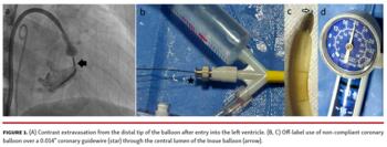 Contrast extravasation from the distal tip of the balloon after entry into the left ventricle. 