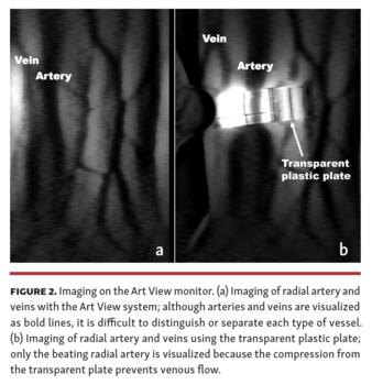 Visualization Device for Transradial Approach Murotani Fig 2