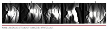 Visualization Device for Transradial Approach Murotani Fig 3