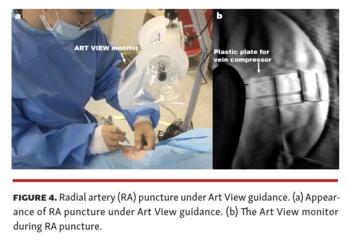 Visualization Device for Transradial Approach Murotani Fig 4