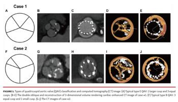 Types of quadricuspid aortic valve (QAV) classification and computed tomography (CT)