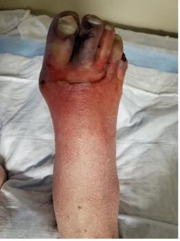 A 52-year-old male presented to the emergency department with frostbite of bilateral feet. Here is the foot six days after injury. 