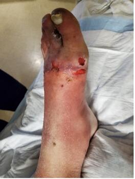 A 52-year-old male presented to the emergency department with frostbite of bilateral feet. Here is the foot six days after injury. 