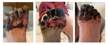 The patient started on cephalexin (Keflex) on admission, but this was switched to clindamycin after seven days, resolving malodorous drainage and erythema. Here is the foot 12 days post-injury.