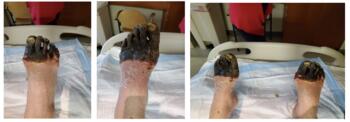 The injury gradually demarcated with dry gangrene of all toes and metatarsal heads at three weeks from presentation on the right foot and four weeks for the left foot. These images show the foot 19 days post-injury.