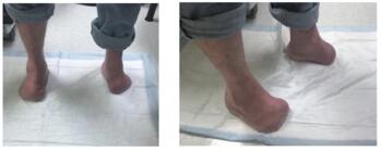 Here is the foot 11 months post-injury. Skin remains closed, neurological deficit has not improved and most likely will be a lifelong sequela of the injury. 