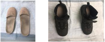 The patient continues to use custom foot orthoses and orthopedic boots to perform his daily routine activities.