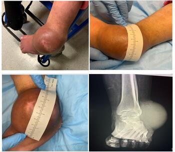Physical exam of the left ankle demonstrated a large, fluctuant soft tissue mass located adjacent to the lateral malleolus.