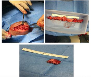 Further wound exploration revealed a firm, heavily encapsulated mass, which was excised.