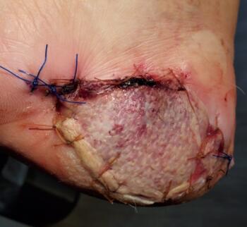 Here one can see the biologic graft 1 week postoperatively. 