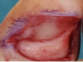 Here one can see wide excision of the lesion.