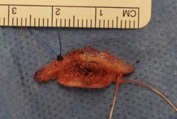This photo shows suture material differentiating distal vs. proximal aspect of lesion for the pathologist.  