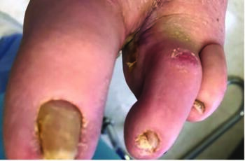 This image shows the area of concern 12 weeks following the initial application, and seven weeks following the second application, of an acellular human dermal allograft (16 weeks after initial operative procedure for source control). Complete wound resolution took place approximately 14 weeks after the second graft application.