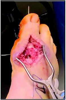 ue to concern for osteomyelitis, surgeons removed the originally placed hardware and stabilized the first MPJ with a K-wire, as seen in this photo.