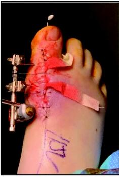 A mini external fixator provided stabilization to the first metatarsal head and proximal phalanx as seen here, along with packing of the open incision.