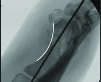 Displacement of the osteotomy in the case above also had a complicating factor of comminution of the dorsal wing, addressed in part with axial fixation.