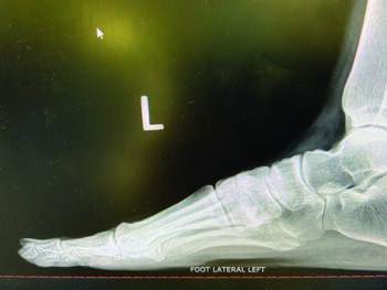 Radiographs such as that seen above allow further assessment of the bunion deformity, including AP, medial oblique, and lateral weight-bearing views.