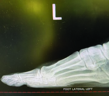 This postoperative radiograph shows a lateral view after a long dorsal arm osteotomy performed for bunion correction with biointegrative nail fixation.