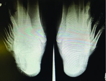 The authors relate a calcaneal axial view, due to the smaller stature of pediatric patients, may also aid in assessment of hindfoot alignment.