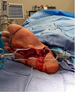 Here one can see an intraoperative view of the incision and drainage procedure.