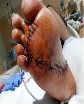 Here one can see the final suture closure after multiple procedures.