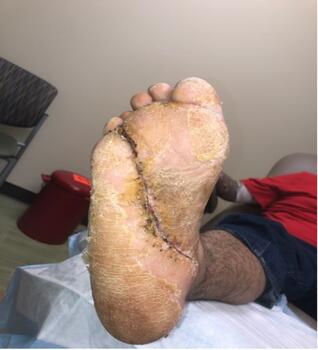 After appropriate identification of organisms and resultant treatment, the patient went on to a full recovery.