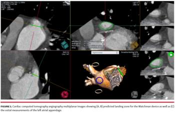 Cardiac computed tomography angiography multiplanar images
