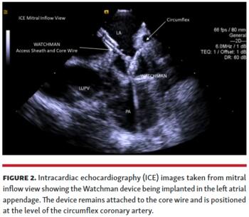 Intracardiac echocardiography (ICE) images taken from mitral inflow view
