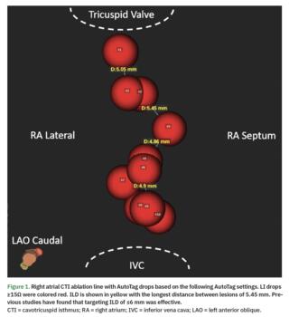 Right atrial CTI ablation line with AutoTag drops based on various AutoTag settings.