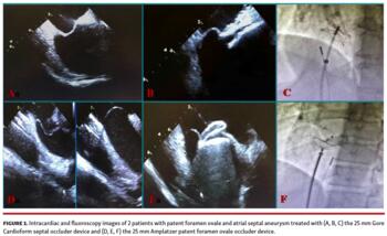 ntracardiac and fluoroscopy images of 2 patients with patent foramen ovale and atrial septal aneurysm