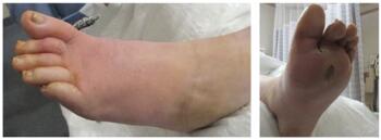 The above images show dorsal (left) and plantar (right) views of the initial presentation of an 82-year-old male with a left plantar diabetic foot ulcer (DFU). The patient also had generalized weakness, midsternal chest pain and shortness of breath. Due to his symptoms and elevated troponin levels, he underwent cardiac catheterization with subsequent emergent cardiac intervention.