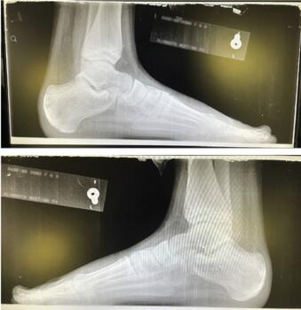 It is critical to perform an appropriate bilateral radiographic evaluation. Assessing the growth plates with no contralateral comparison may lead to misdiagnosis.