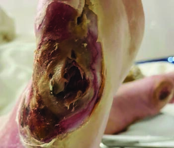 The current literature is sparse in regard to studies examining how remaining fifth metatarsal length impacts outcomes after partial fifth ray resection procedures. However, a recent multicenter study undertook this investigation in 117 patients.