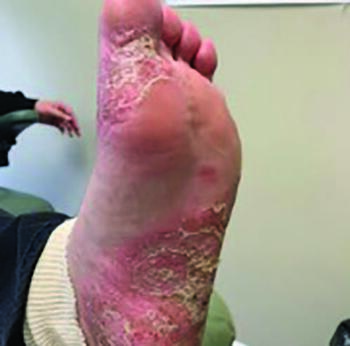 Here one can see the plantar medial aspect of the foot, including the rash, on initial presentation.