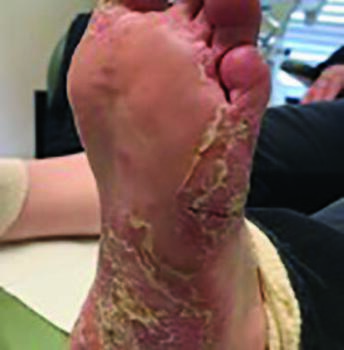 In this photograph, one can see the plantar lateral aspect of the rash, which was very itchy and painful.