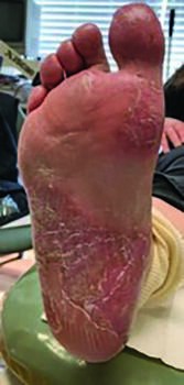 Here one can see the same foot described previously, with significant improvement to the rash on the sole.