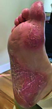 In this different photographic view of the same foot as to the left, the improvement within five days is apparent.