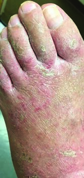 Spread of an allergic contact dermatitis reaction can occur by scratching the affected site and subsequently scratching another area of the body.