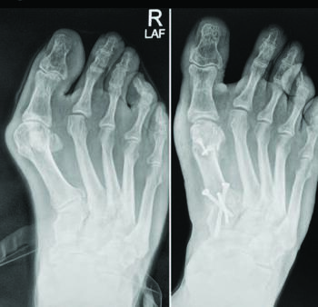 Various described soft tissue and osseous procedures for compound foot deformities involving metatarsus adductus can carry risk of residual deformity. Other possible complications include disruption of the metatarsal parabola or overtightening of the plantar soft tissues.