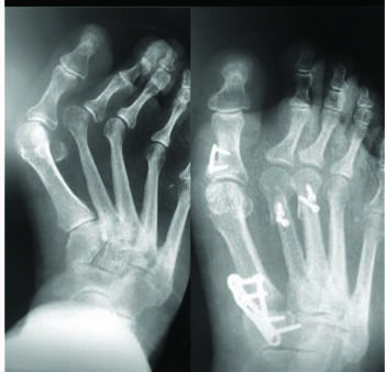 Various described soft tissue and osseous procedures for compound foot deformities involving metatarsus adductus can carry risk of hallux valgus recurrence. Other possible complications include disruption of the metatarsal parabola or overtightening of the plantar soft tissues.