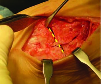 The keystone midfoot anatomy creates a ‘stair-step’ offset, requiring planing to accept the lesser TMT cutting guide in the technique described by the author.