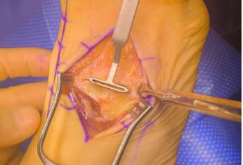In this photo, the surgeon resects the superior joint apices with a planing guide to revise joint anatomy to accept the keel of the lesser TMT cut guide.