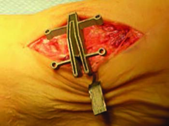 The cut guide keel for the novel technique described interfaces with the second and third TMT, with the cut slots over the joint spaces in their respective planes.