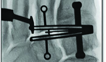 The cannulated outrigger fixation points seen here provide a fluoroscopic visual reference to ensure there is no parallax when determining the guide position.