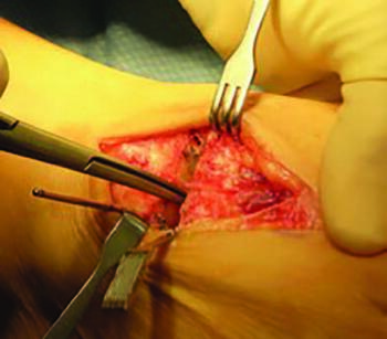 The goal of the cut guide anatomy is to allow for creation of a continuous angular bone cut at both the metatarsal and cuneiform joint surfaces, as seen in this photo.